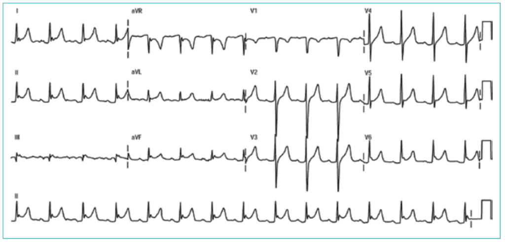 Electrocardiograma que muestra elevación del segmento ST en múltiples derivaciones, compatible con pericarditis.