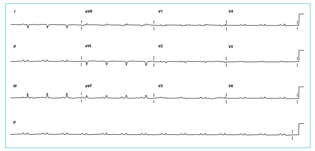 Complejos QRS de bajo voltaje.
