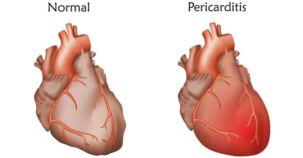 pericarditis