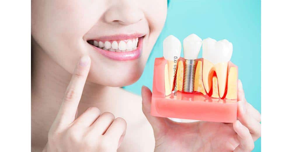 Qué es la Periimplantitis, Síntomas y Tratamiento